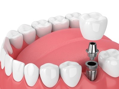 Single tooth replacement