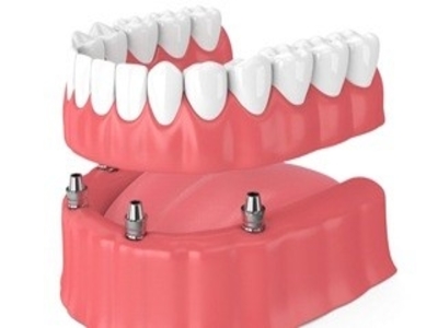 Full tooth replacement