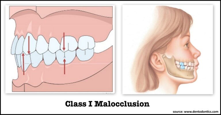 malocclusion-of-teeth-what-is-it-k-smile-dental-care