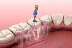 Do-You-Really-Need-Root-Canal-Treatment (1)