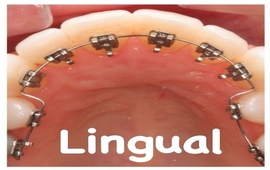 Lingual orthodontics
