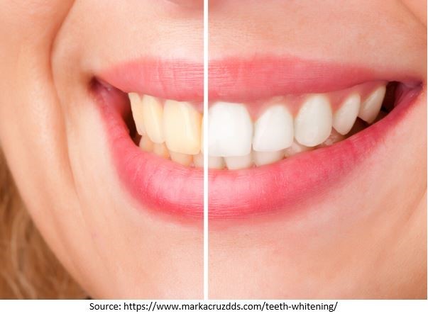 What is Teeth Whitening