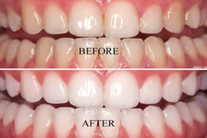 teeth-whitening (1)