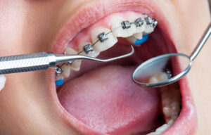 What is Included in Orthodontic Treatment? | Pasadena, CA