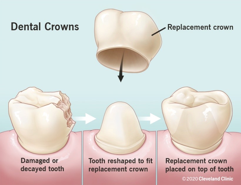 Dental Crowns Everything You Need To Know K Smile Dental Care