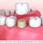 Ceramic Dental Crowns