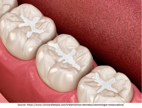 Tooth-Coloured Restorations