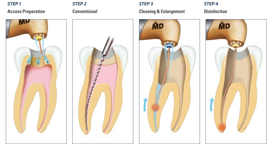 treatment of root canals
