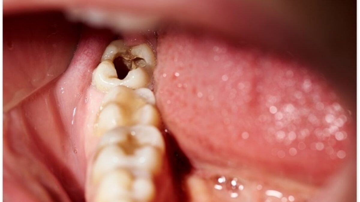 Tooth cavity treatment