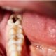 Tooth cavity treatment