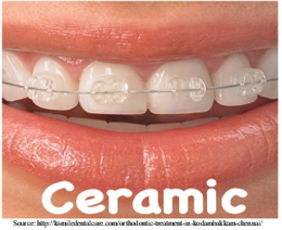 Ceramic brackets