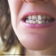 Teeth Alignment Treatment