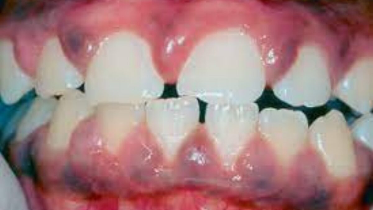 Gingivitis in Children - Symptoms and Treatment in Kodambakkam | K