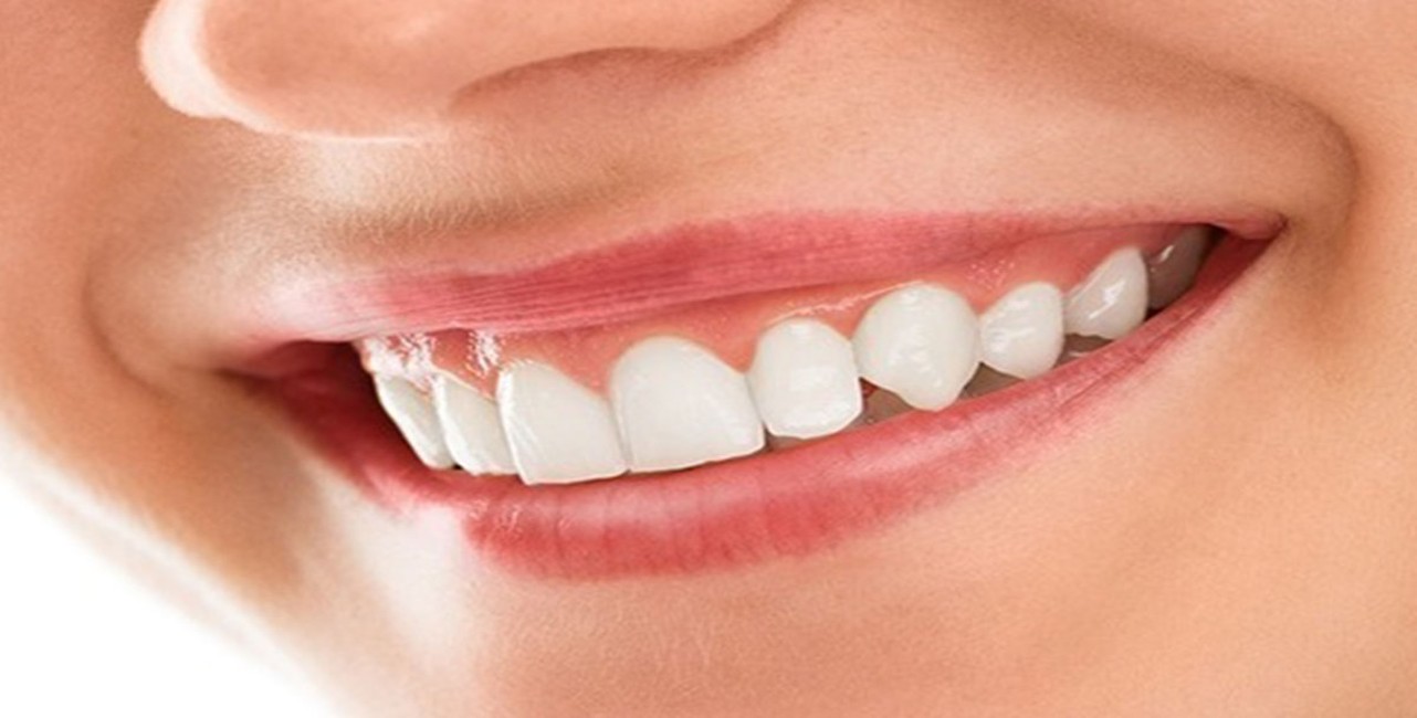 Smile-makeover (2)